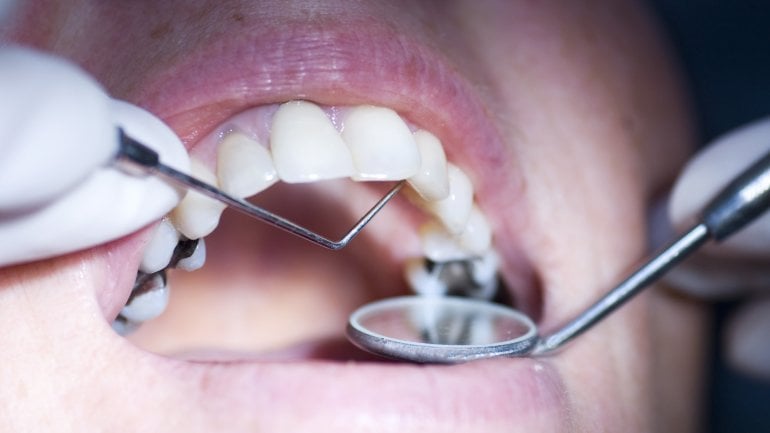 Amalgam: Untersuchung beim Zahnarzt