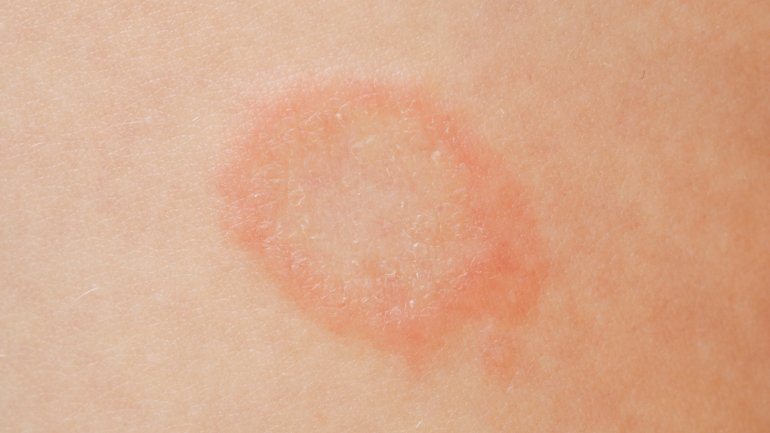 Tinea: Bild von einer Infektion mit Dermatophyten.