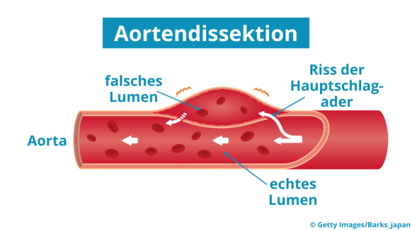 Grafische Darstellung einer Aortendissektion. | © © Getty Images/Barks_japan