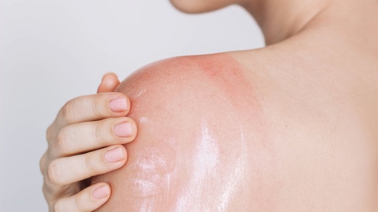 Sonnenbrand: After Sun Lotion als Hausmittel?