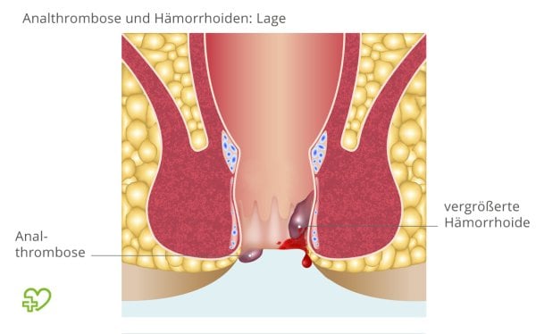 Eine Analthrombose entsteht am Analrand, vergrößerte Hämorrhoiden befinden sich dagegen im Inneren des Afters. | © © iStock