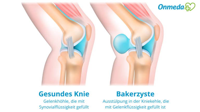 Grafik einer Bakerzyste