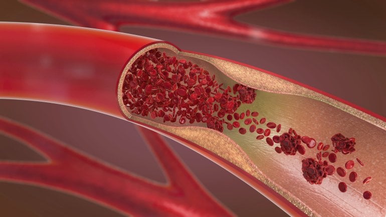 Thrombose: Mögliches Anzeichen für Bauchspeicheldrüsenkrebs