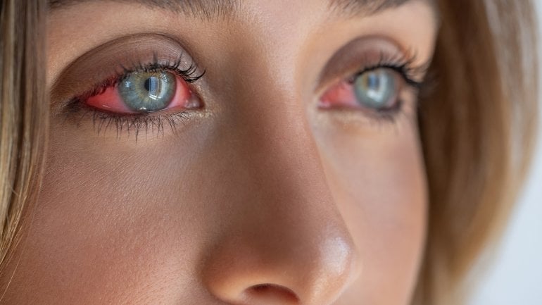 Bindehautentzündung: Gerötete Augen sind mögliches Symptom