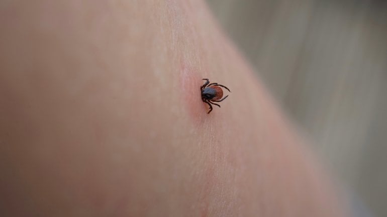 Borreliose: Zeckenstich auf der Haut