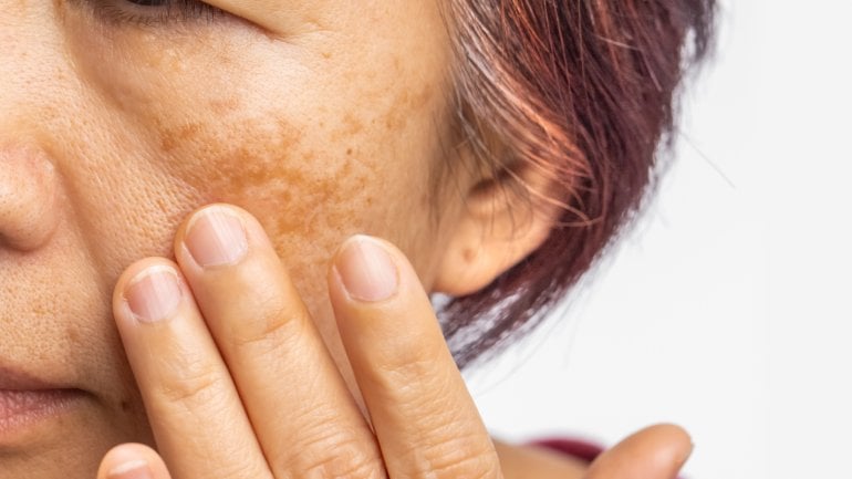  Frau mit Melasma im Gesicht.