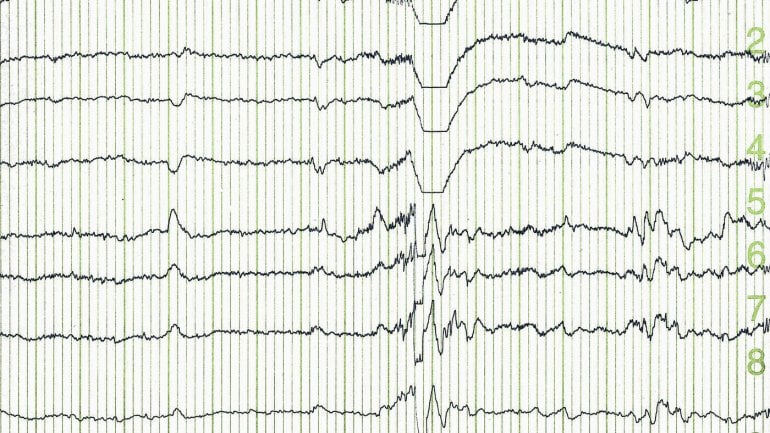 Man sieht den Ausdruck eines Elektroenzephalogramms.