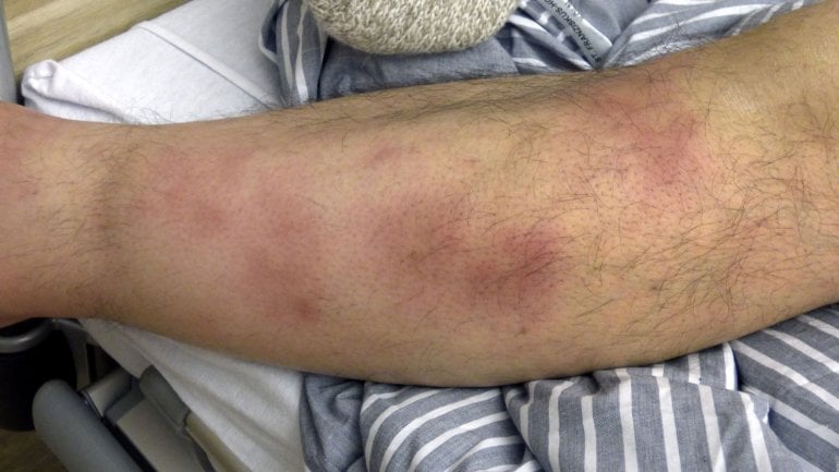 Erythema nodosum Bilder: Knoten unter der Haut