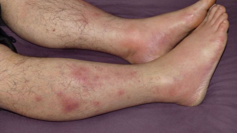 Erythema nodosum Bilder: An welchen Körperbereichen?