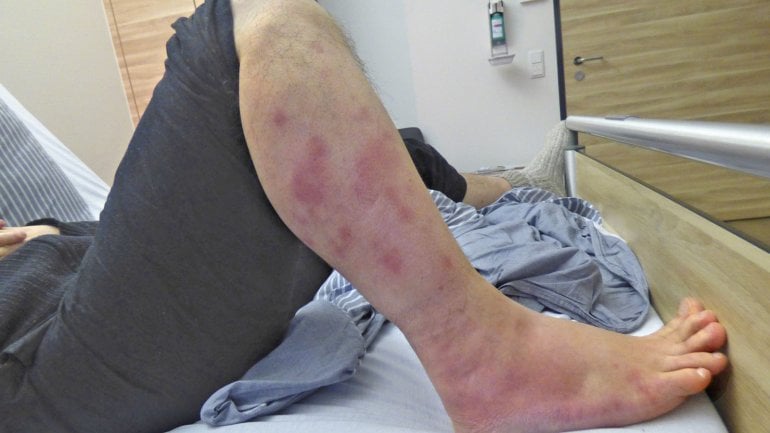 Erythema nodosum: Schmerzen und Gelenkschwellung sind Symptome