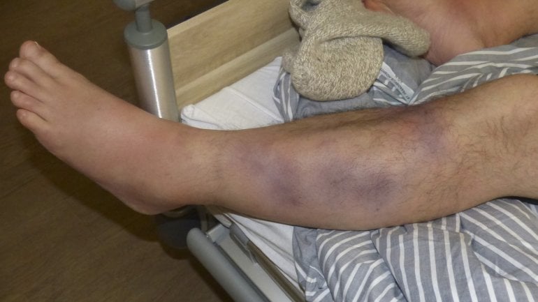 Erythema nodosum: Bilder vom Heilungsverlauf