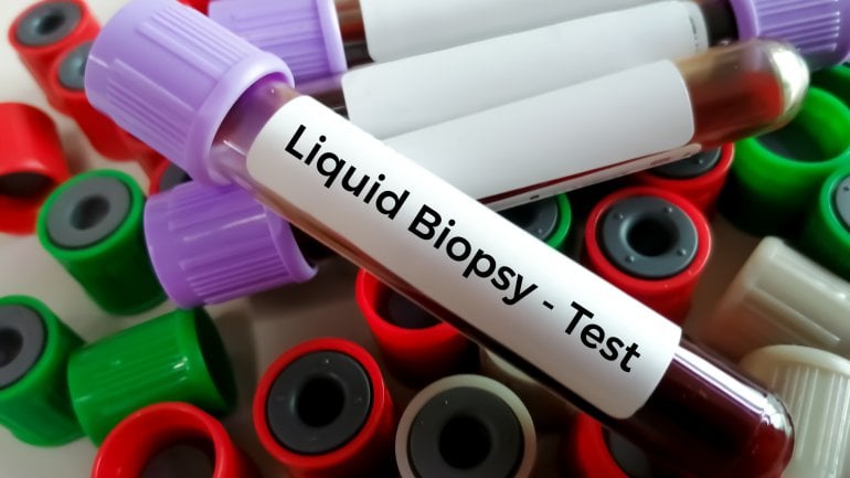 Bluttest bei Krebs: Liquid Biopsy