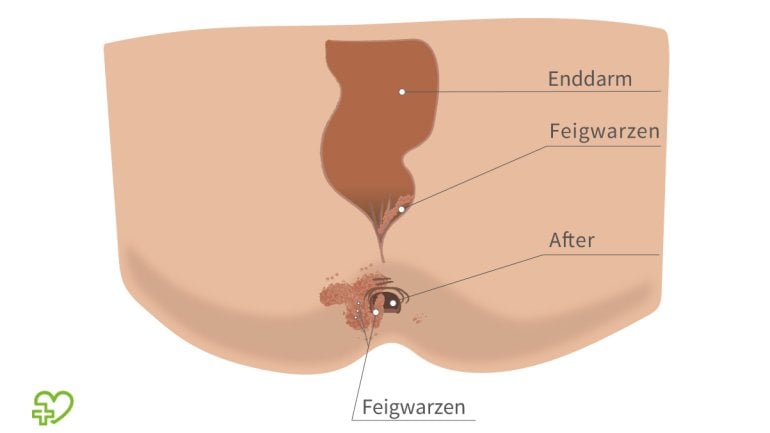 Feigwarzen am After und Mund