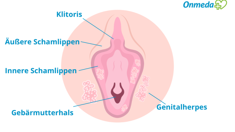 Genitalherpes: Aussehen von Herpes genitalis bei der Frau
