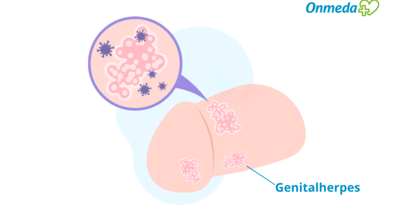 Wie sieht Genitalherpes beim Mann aus?