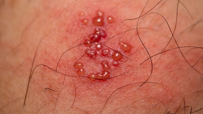 Genitalherpes: Foto von Bläschen im Intimbereich