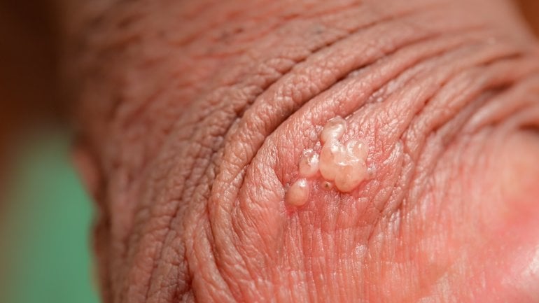 Foto von Herpes am Penis