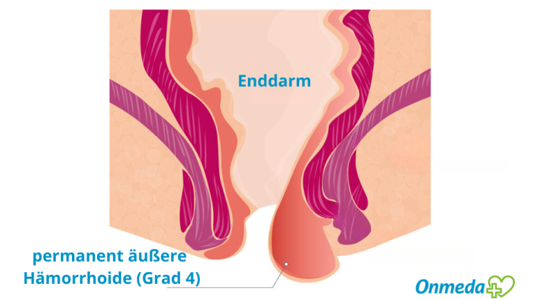 Bild von dauerhaft außenliegenden Hämorrhoiden