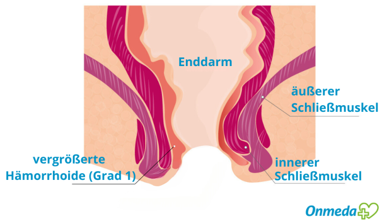 Vergrößerte Hämorrhoiden: Bild vom Grad 1