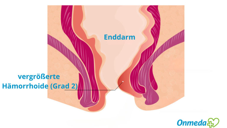 Bild von vergrößerter, innerer Hämorrhoide