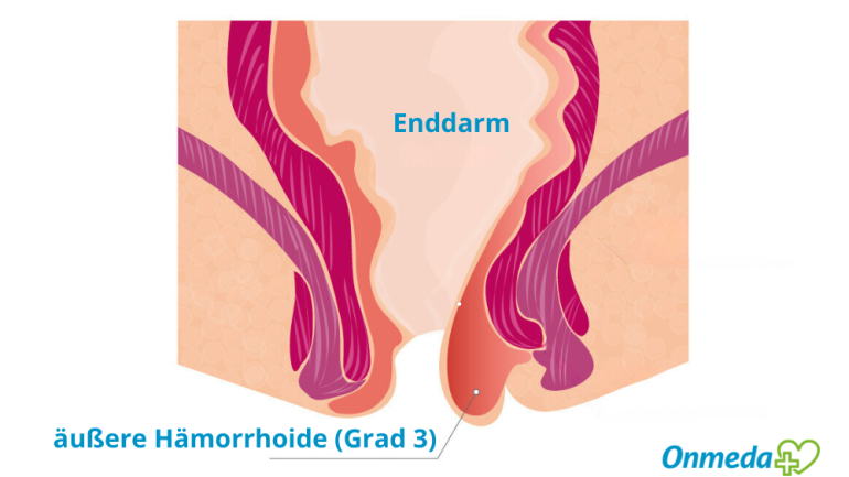 Bild: Wie sehen außenliegende Hämorrhoiden aus?