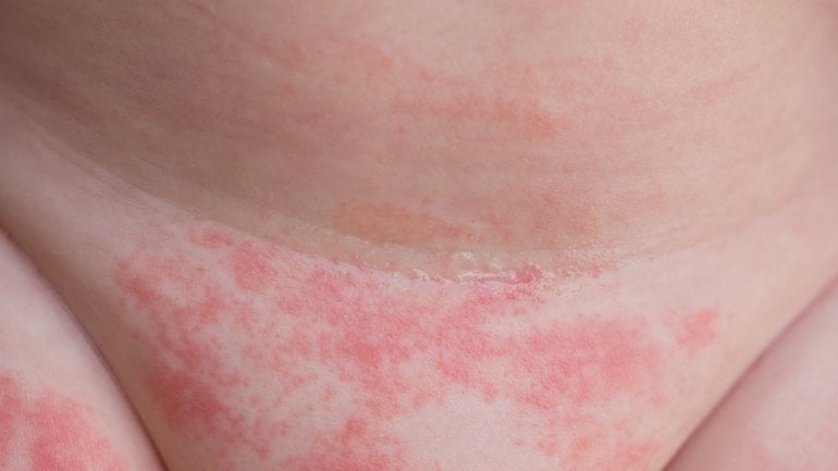 Hautausschlag bei Kindern: Windeldermatitis 