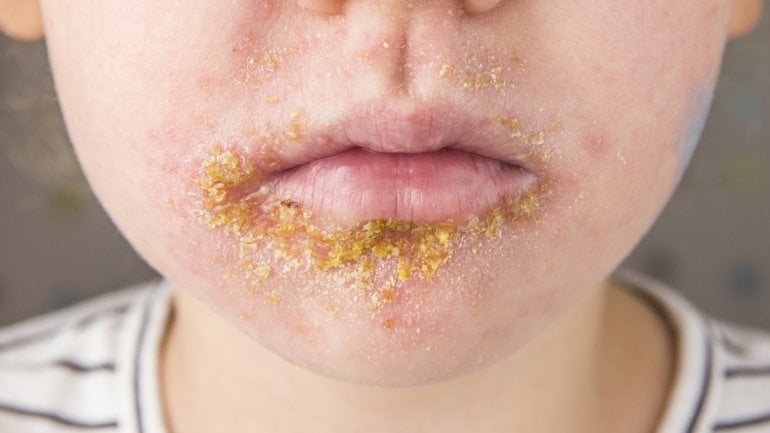 Impetigo contagiosa: Foto von Hautausschlag bei Borkenflechte