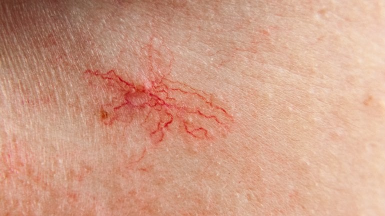 Hautausschlag-Bilder: Spider Naevi bei Erkrankungen der Leber