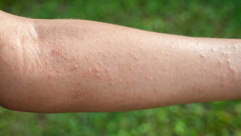 Grippaler Infekt: Hautausschläge beim Kind und bei Erwachsenen