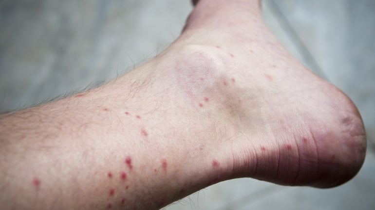 Bilder: Milben können Hautausschlag auslösen