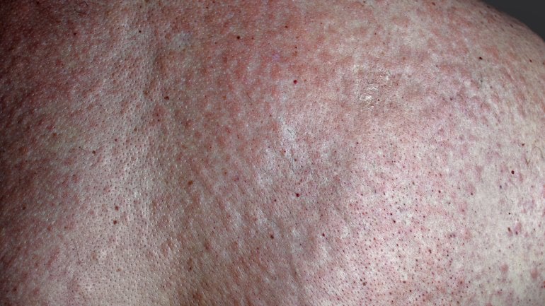 Hautausschläge: Bilder eines Arzneimittelexanthems