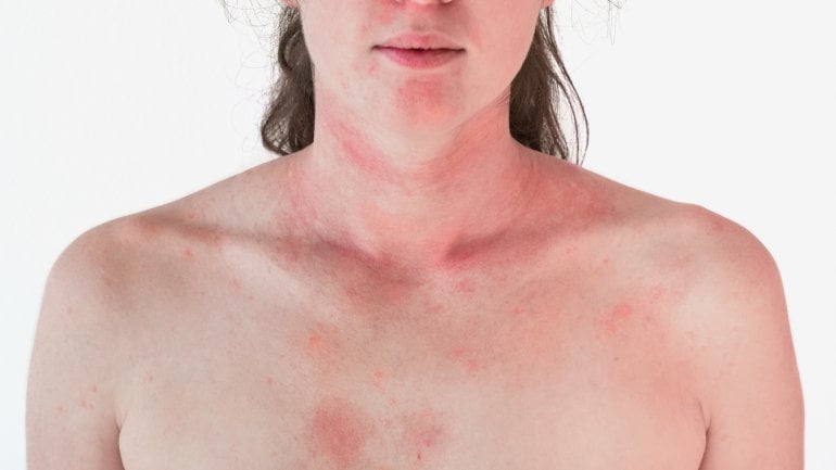 Allergie: Plötzlicher Hautausschlag ist typisch