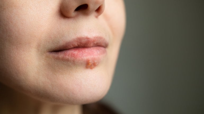 Hautausschlag-Bilder: Lippenherpes
