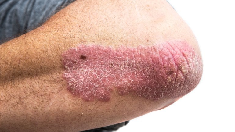 Schuppenflechte: Bilder vom Ausschlag bei Psoriasis