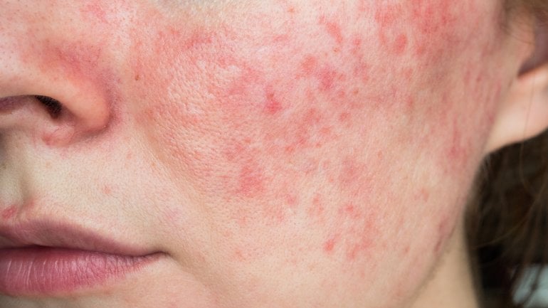 Rosacea: Hautkrankheit erkennen