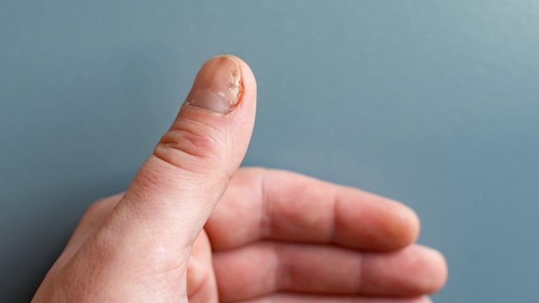 Hautkrankheiten erkennen: Bild von Nagelpsoriasis