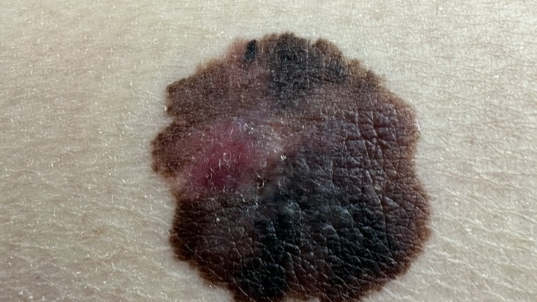 Schwarzer Hautkrebs: Bilder von Melanomen