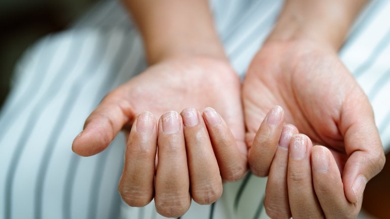 Nagelveränderungen: Anzeichen einer Mangelerscheinung