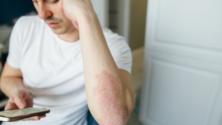 Psoriasis: Ellbogen häufig von Schuppenflechte betroffen