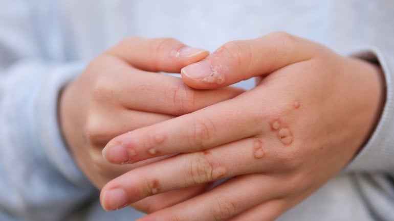 Vulgäre Warzen an Finger und Hand