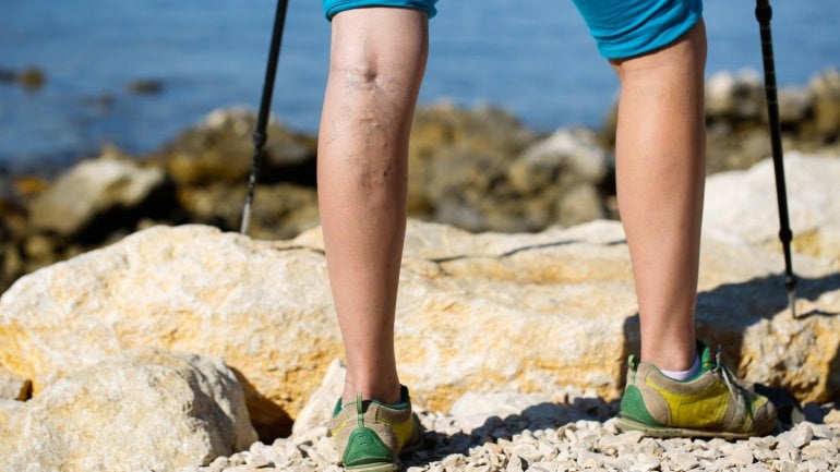 Häufige Ursache von Wasser in den Beinen: Venenschwäche