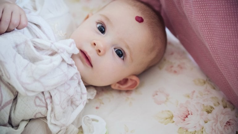 Ein Baby mit einem Hämangiom auf der Stirn