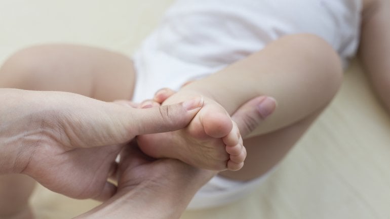 Person hält Klumpfuß eines Kindes in der Hand.