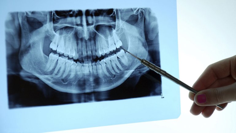 Ein Gebiss im Röntgenbild