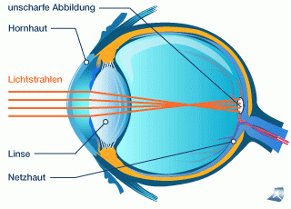 Verlängerter Augapfel bei Kurzsichtigkeit | © © Onmeda