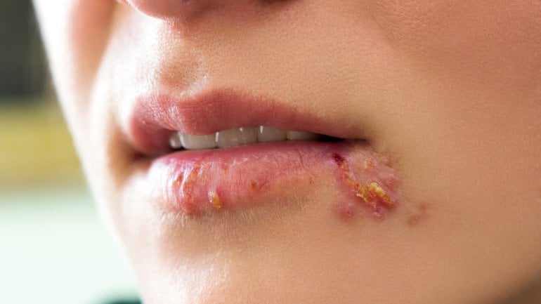 Bild: Lippenherpes kann sich ausbreiten