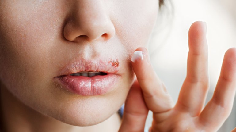 Bild einer Frau mit Lippenherpes, die Creme auf ihrem Finger hat.