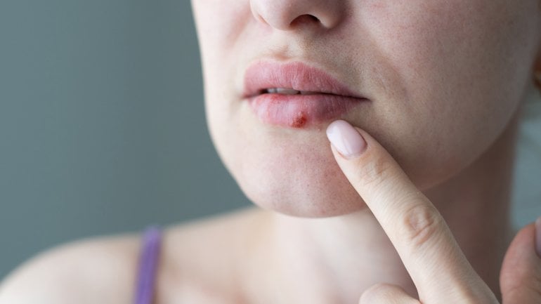 Meist ist Lippenherpes harmlos