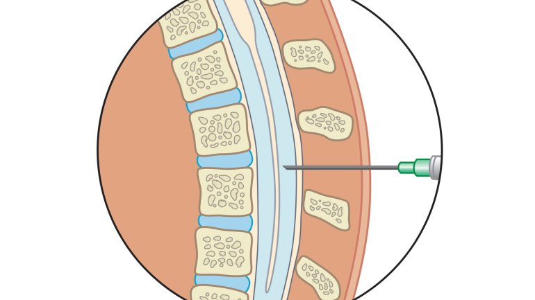 Man sieht die schematische Darstellung eine Lumbalpunktion.