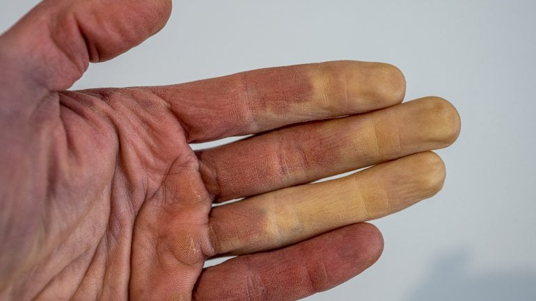 Raynaud-Syndrom kann Symptom bei Lupus sein